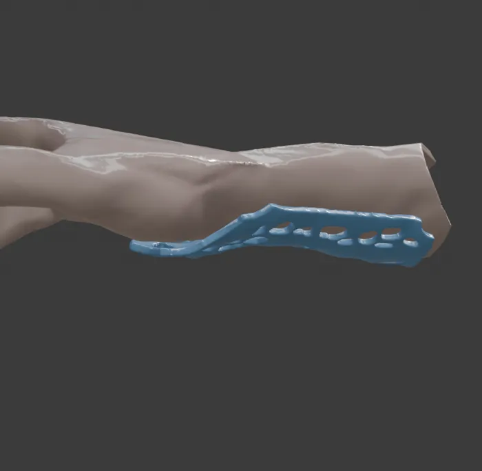 Custom wrist splint shell on the forearm, radial view